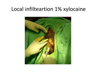 Local infilteartion 1% xylocaine
 