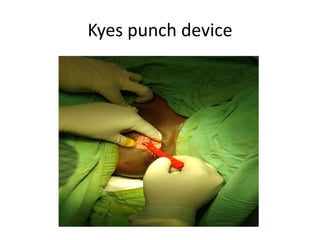 Kyes punch device
 