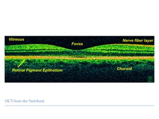 OCT-Scan der Netzhaut
 