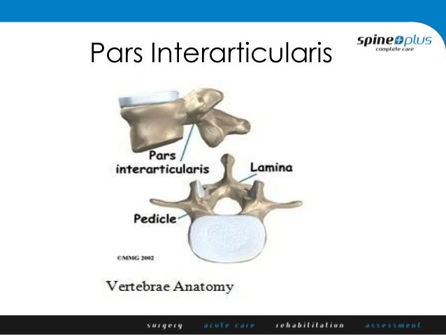 Pars defects and spondylolisthesis