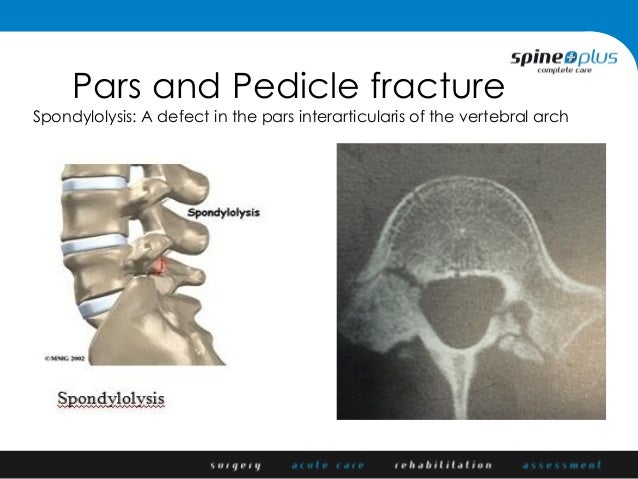 pars defect with spondylolisthesis