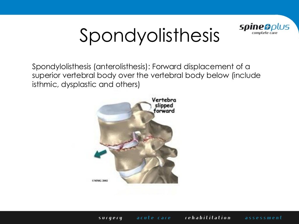 Pars Defect Hardware Repair Of Pars Defects And Spondylosis – MJQU