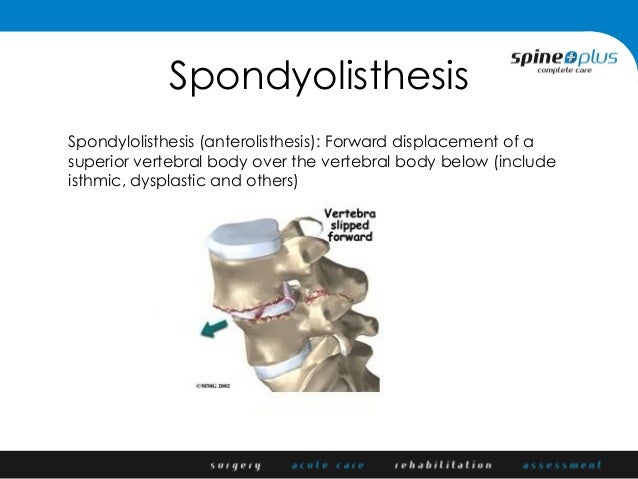pars defect with spondylolisthesis pars defect with spondylolisthesis