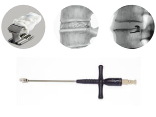Current concepts in management of lumbar disc prolapse | PDF