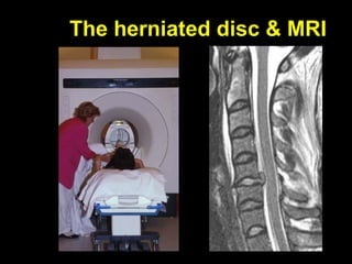 The herniated disc & MRI
 