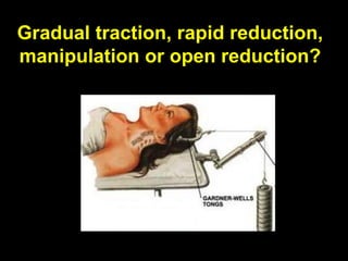 Gradual traction, rapid reduction,
manipulation or open reduction?
 