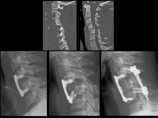 Facet dislocation management