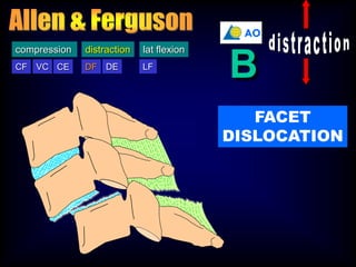 DF DECF VC CE LF
compression distraction lat flexion
DF
distraction
AO
B
FACET
DISLOCATION
 