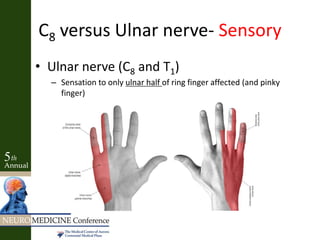 C8 versus Ulnar nerve- Sensory
• Ulnar nerve (C8 and T1)
– Sensation to only ulnar half of ring finger affected (and pinky
finger)
 