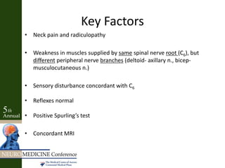 Key Factors
• Neck pain and radiculopathy
• Weakness in muscles supplied by same spinal nerve root (C6), but
different peripheral nerve branches (deltoid- axillary n., bicep-
musculocutaneous n.)
• Sensory disturbance concordant with C6
• Reflexes normal
• Positive Spurling’s test
• Concordant MRI
 