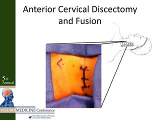 Anterior Cervical Discectomy
and Fusion
 