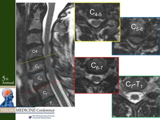 C5-6
C4-5
C7-T1
C6-7C5
C6
C7
T1
C4
 