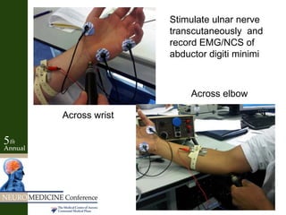 Stimulate ulnar nerve
transcutaneously and
record EMG/NCS of
abductor digiti minimi
Across wrist
Across elbow
 