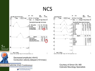 Courtesy of Simon Oh, MD
Colorado Neurology Specialists
Decreased amplitude (>6mV)
Conduction velocity delayed (>51m/sec)
NCS
 