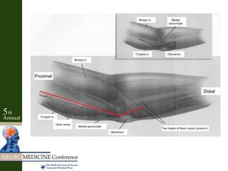 Olecrenon
Distal
Proximal
Tricepts m.
Ulnar nerve
Medial epicondyle
Two heads of flexor carpis ulnaris m.
Biceps m.
Tricepts m.
Biceps m. Medial
epicondyle
Olecrenon
 