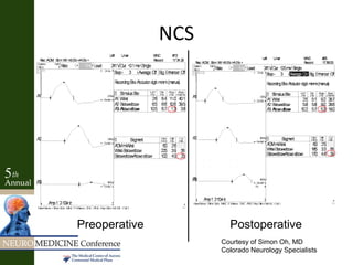 Preoperative Postoperative
Courtesy of Simon Oh, MD
Colorado Neurology Specialists
NCS
 