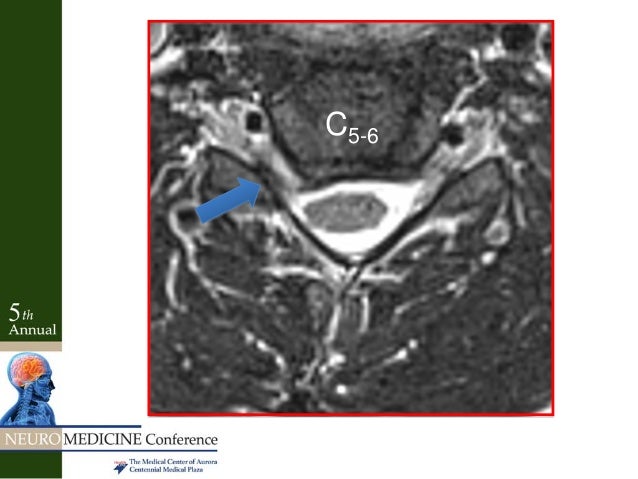 radiculopathy vs peripheral neuropathy radiculopathy vs neuropathy