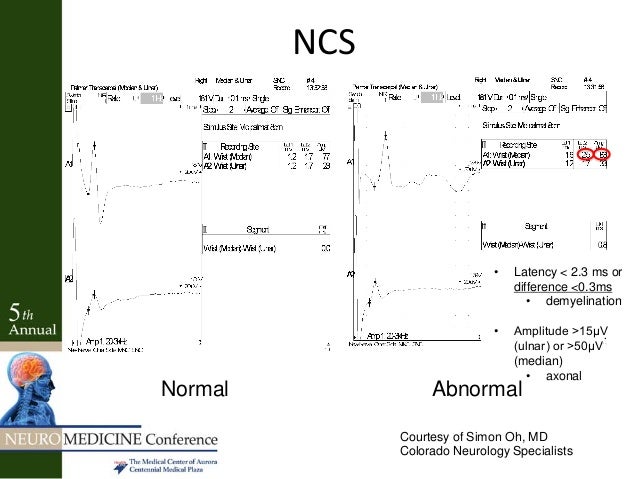 radiculopathy vs peripheral neuropathy radiculopathy vs neuropathy