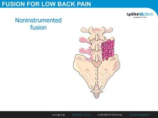 FUSION FOR LOW BACK PAIN
Noninstrumented
fusion
 