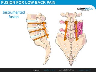 Instrumented
fusion
FUSION FOR LOW BACK PAIN
 