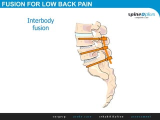 FUSION FOR LOW BACK PAIN
Interbody
fusion
 
