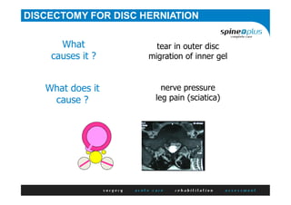 DISCECTOMY FOR DISC HERNIATION
tear in outer disc
migration of inner gel
What
causes it ?
nerve pressure
leg pain (sciatica)
What does it
cause ?
 