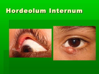 Lid diseases i | PPT