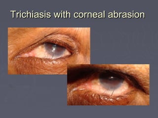 Trichiasis with corneal abrasion
 