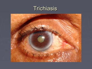 Trichiasis
 