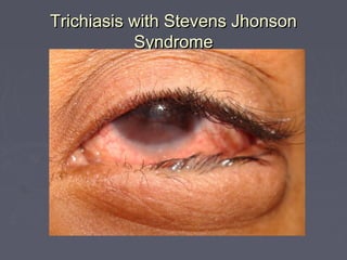 Trichiasis with Stevens Jhonson
           Syndrome
 