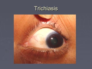 Trichiasis
 