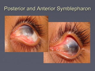 Posterior and Anterior Symblepharon
 