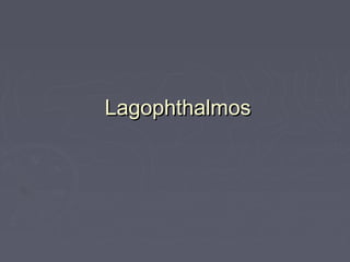 Lagophthalmos
 