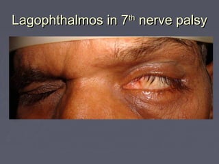 Lagophthalmos in 7 nerve palsy
                 th
 