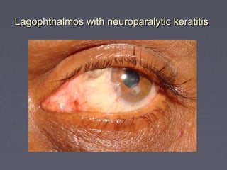 Lagophthalmos with neuroparalytic keratitis
 