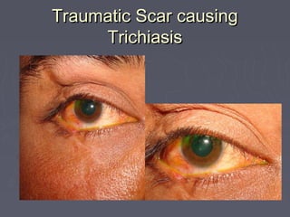 Traumatic Scar causing
     Trichiasis
 