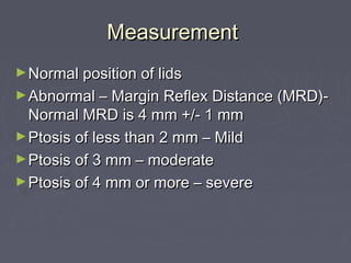 Measurement
► Normal position of lids
► Abnormal – Margin Reflex Distance (MRD)-
  Normal MRD is 4 mm +/- 1 mm
► Ptosis of less than 2 mm – Mild
► Ptosis of 3 mm – moderate
► Ptosis of 4 mm or more – severe
 