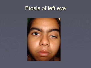 Ptosis of left eye
 