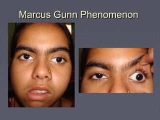 Marcus Gunn Phenomenon
 