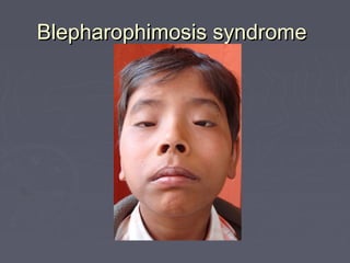 Blepharophimosis syndrome
 