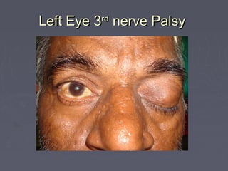 Left Eye 3 nerve Palsy
         rd
 