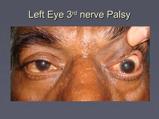 Left Eye 3 nerve Palsy
         rd
 