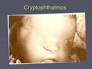 Cryptophthalmos
 