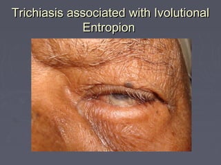 Trichiasis associated with Ivolutional
             Entropion
 