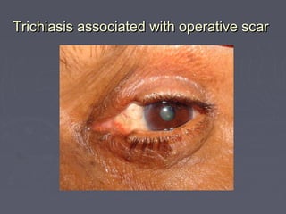 Trichiasis associated with operative scar
 