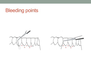 procedures of periodontal surgery(gingival surgery), WOLAITA SODO ...