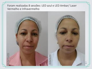 Foram realizadas 8 sessões: LED azul e LED Ambar/ Laser
Vermelho e Infravermelho
 