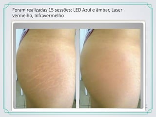 Foram realizadas 15 sessões: LED Azul e âmbar, Laser
vermelho, Infravermelho
 