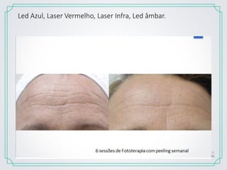 Led Azul, Laser Vermelho, Laser Infra, Led âmbar.
 