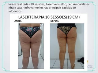 Foram realizadas 10 sessões, Laser Vermelho, Led Ambar/laser
infra e Laser Infravermelho nas principais cadeias de
linfonodos.
 